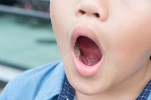 Orofacial Myofunctional Therapy